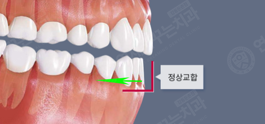 5. 방이동 돌출입교정 앞니가 과도하게 안으로 기울어진 옥니 비교 이미지2