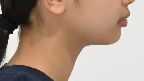 무턱 성장 유도 사례 03 얼굴 옆모습 치료 전