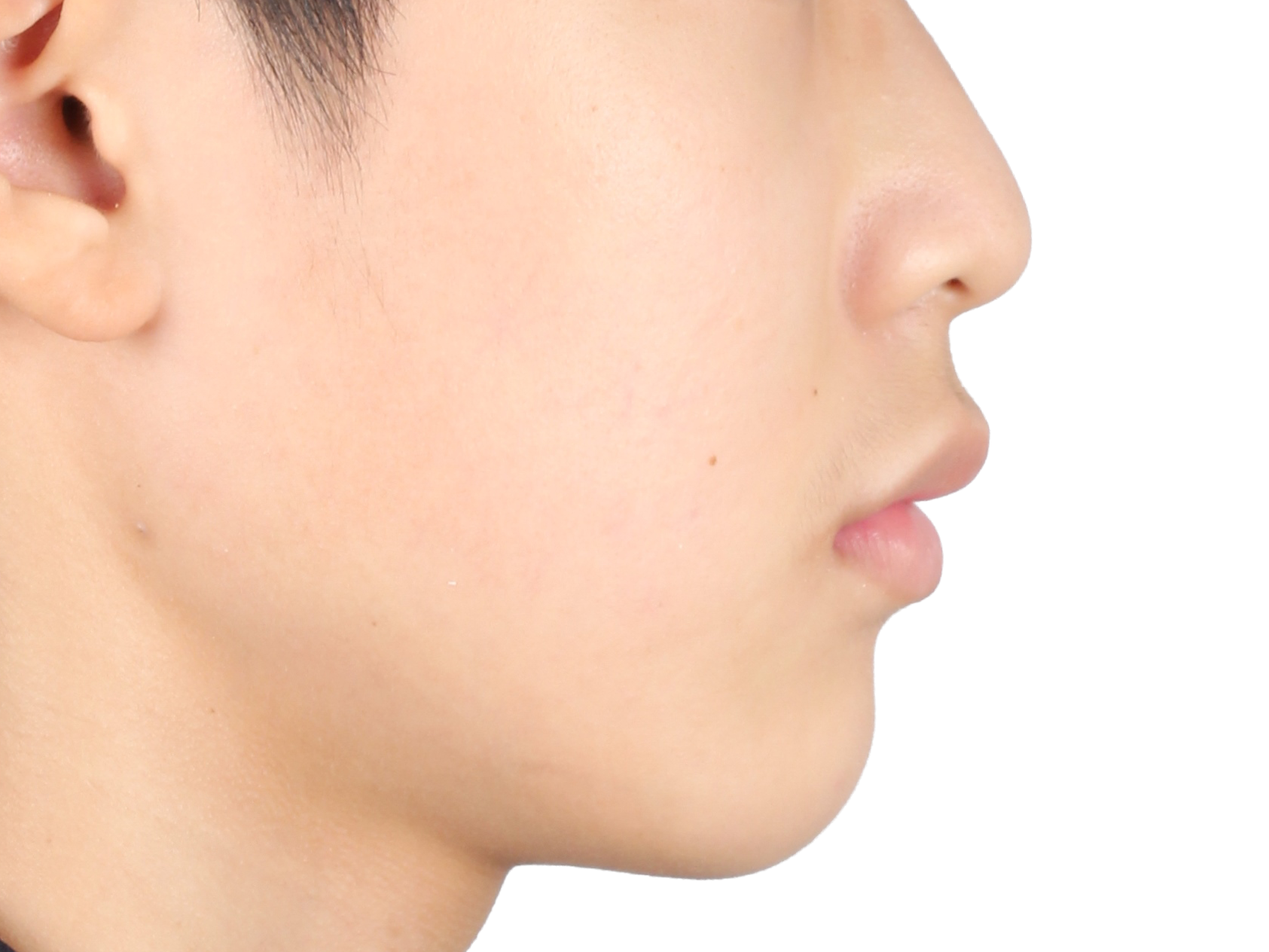 돌출입 교정 사례 03 얼굴 옆모습 치료 후