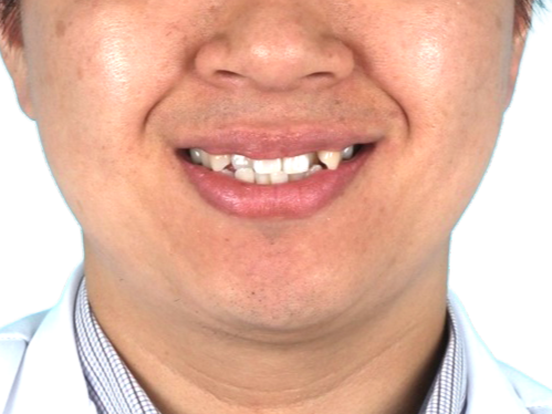 중심선 · 비대칭 사례 03 얼굴 정면 치료 전