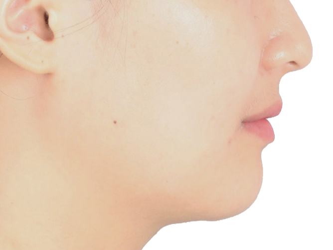 무턱 교정 사례 02 얼굴 옆모습 치료 후